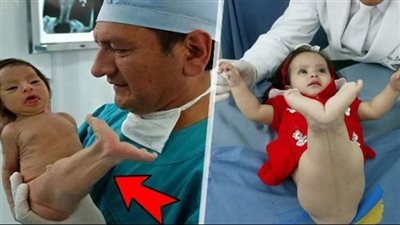 سخـروا من هذه الطفلة لأنها ولدت تشبه حورية البحر…بعد 5 سنوات صدموا كيف أصبحت !!!