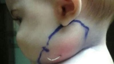 اعتقدت الأم أنها مجرد بثرة لكن عندما فتح الطبيب وسحبها صدم الجميع بما رأوه وحذروا جميع الأمهات