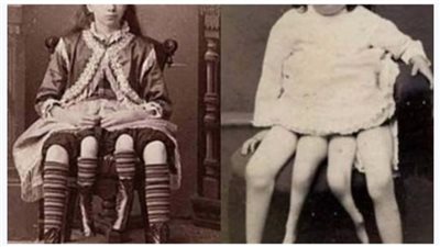 قصة فتاة ولدت في الولايات المتحدة بأربع أرجل