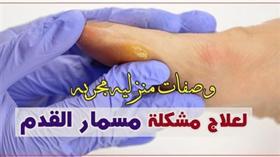 علاج مسمار القدم ١٣ وصفة مفعولها سريع بدون أثار جانبية