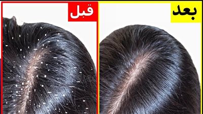 وصفة طبيعية سحرية (من مطبخك) للتخلص من قشرة الشعر للأبد! 