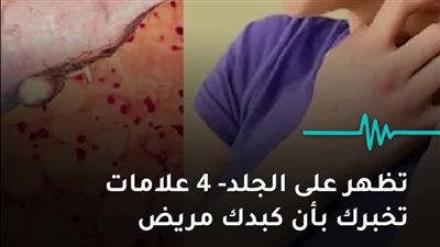 أمراض مزمنة تظهر على الجلد- 4 علامات تخبرك بأن كبدك مريض