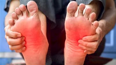 عندما تتحول خطواتك إلى جمر 5 أسباب طبية وراء حړقان القدمين وحلول منزلية للتهدئة