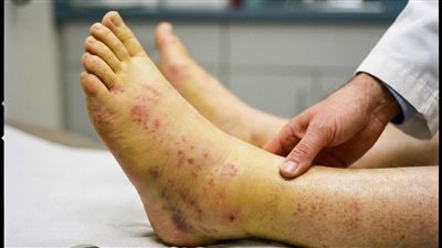 أعراض ضعف وظائف الكبد- 7 علامات تظهر على القدمين